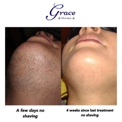 WHY GRACE SCIENTIFIC ELECTROLYSIS CENTRE?