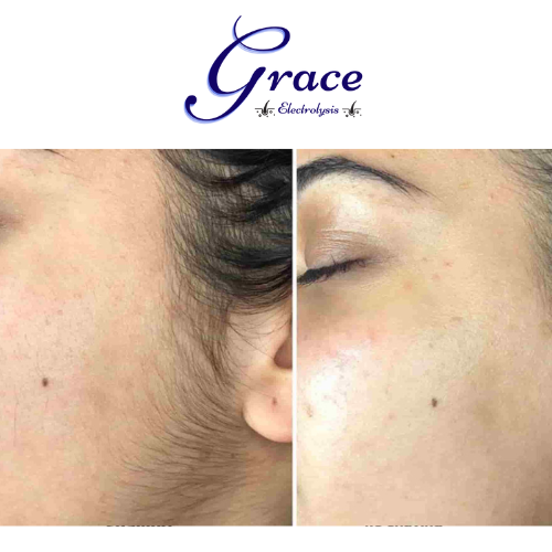 WHY GRACE SCIENTIFIC ELECTROLYSIS CENTRE?