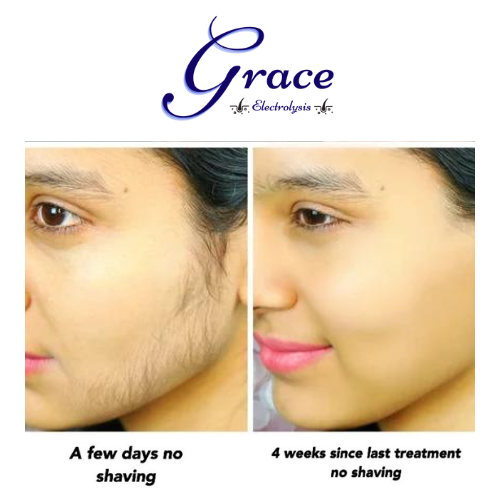 WHY GRACE SCIENTIFIC ELECTROLYSIS CENTRE?